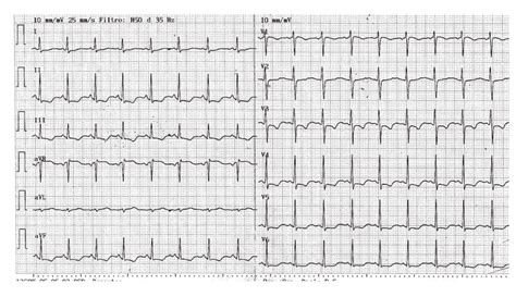 Ekg Showing St Depression In Leads Ii Iii Avf And V3 V6 Download