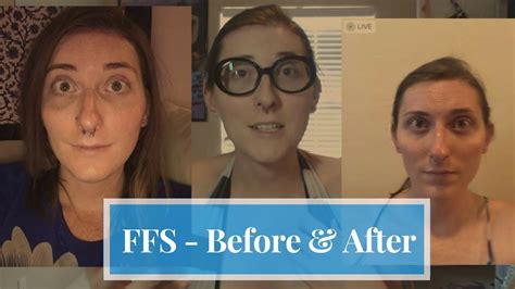 Ffs Before And After 7 Weeks Post Op Mtf Transgender I Facial