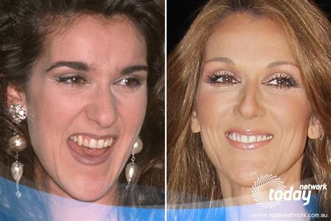 Celine Dion Before And After Celebrity Before And After
