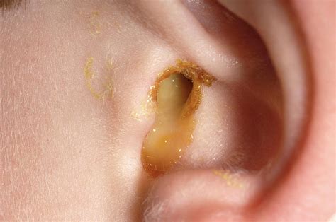 Ear Infection Photograph By Dr P Marazziscience Photo Library