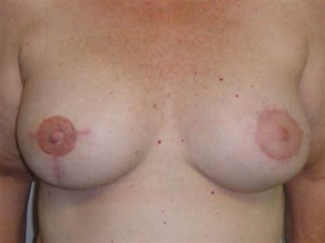 Before And After Breast Reconstruction Patient 02 Photos Dr Eva