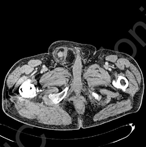 Ct Showing An Incarcerated Right Inguinal Hernia With Small Bowel In