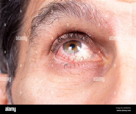 Macro Of The Eye Of A Caucasian Man Suffering From Uveitis Eye With