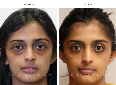Before And After Eyelid Treatment By A Uk Eyelid Surgeon Daniel Ezra