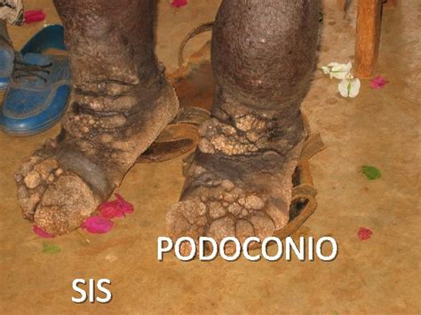 What Is Podoconiosis 1 Noninfectious Elephantiasis Swelling Of