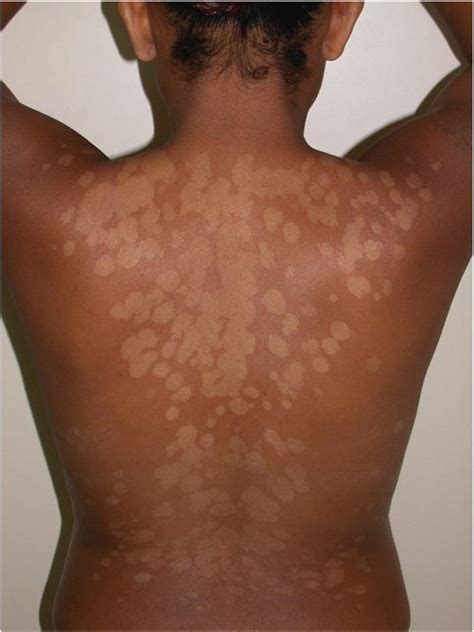 Tinea Versicolor Tinea Nigra White Piedra And Black Piedra Clinics In Dermatology