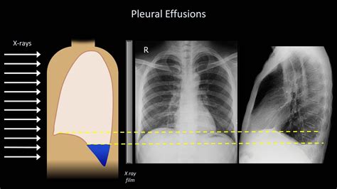 Chest X Ray Pleural Effusion Interpretation
