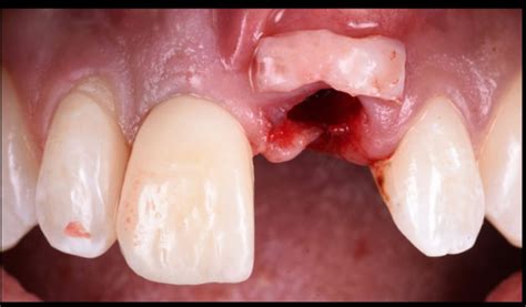 Advanced Soft Tissue Around Dental Implants Dental Cpd Courses