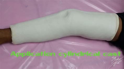 Application Plaster Cylindrical Cast By Rake Krittanai Youtube