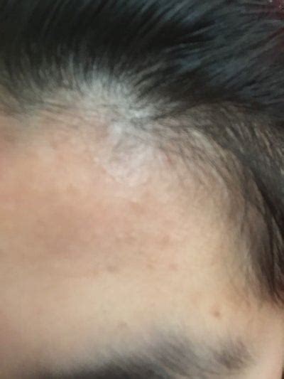 Little Bumps On Foreheadsubclinical Acne Clogged Pores Photo
