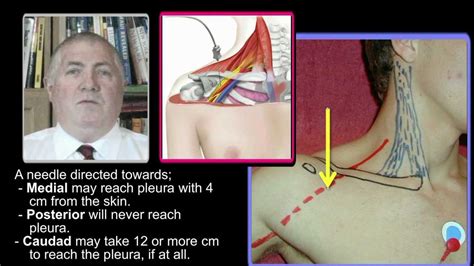 Ultrasound Guided Infraclavicular Nerve Block Youtube