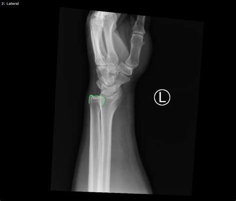 Druj Wrist Xray Lateral Annotated Jetem 2020 Jetem