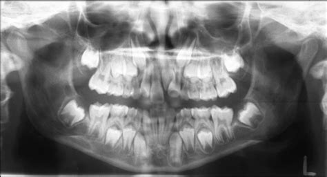Figure 1 From Orthodontic Uprighting Of Severely Impacted Mandibular
