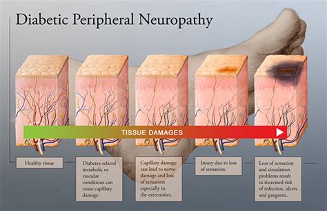 Diabetic neuropathy is nerve damage that affects a range of nerves in the bodies of some people with diabetes. VitalScan