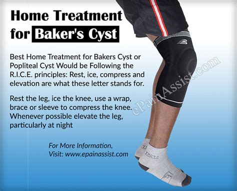 Bakers Cyst Or Popliteal Cystcausessymptomstreatmentexercisehome
