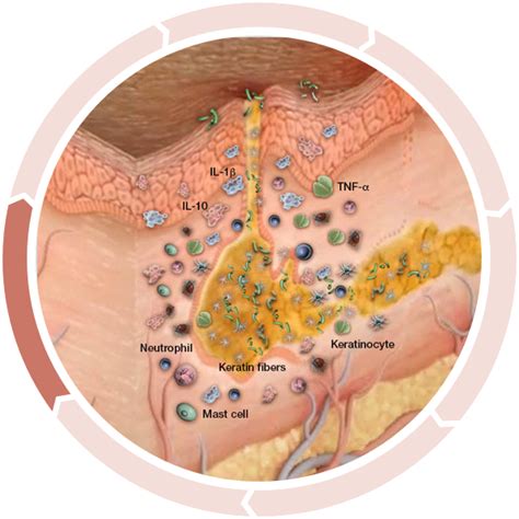 Hidradenitis Suppurativa Hs Causes And Inflammation