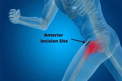 Anterior Vs Posterior Hip Replacement Which Is Better