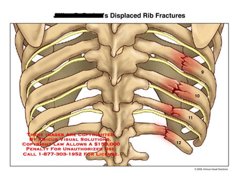 Amicus Illustration Of Amicus Injury Ribs Fractures Posterior Fractured Broken
