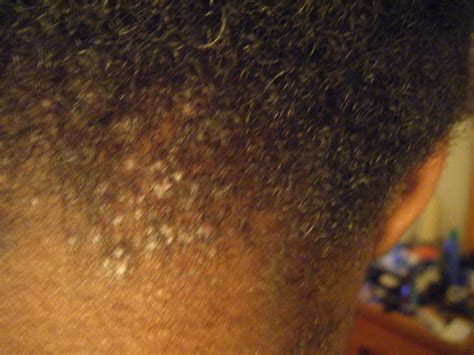 Acne Just Aboveat My Hairline On The Back Of My Neck Need Help Please