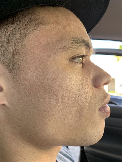 Help With My Husbands Uneven Skin Texture From Past Acne Skincareaddicts