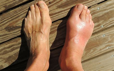 Three Common Foot Problems Symptoms And Treatment Massage And Spa Blog