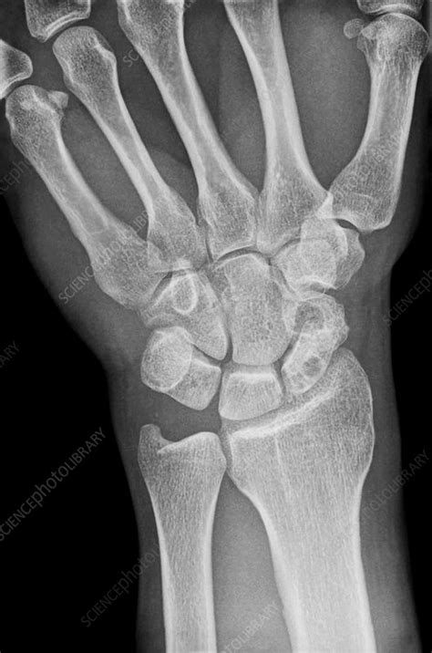 Fractured Scaphoid Wrist Bone X Ray Stock Image C038