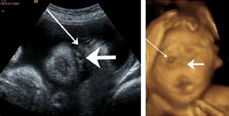 Figure 4 From Alobar Holoprosencephaly Proboscis And Cyclopia In A