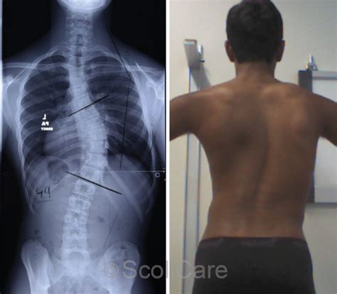 Reduction Of A Severe Scoliosis Using Scoliosis Specific Rehabilitation