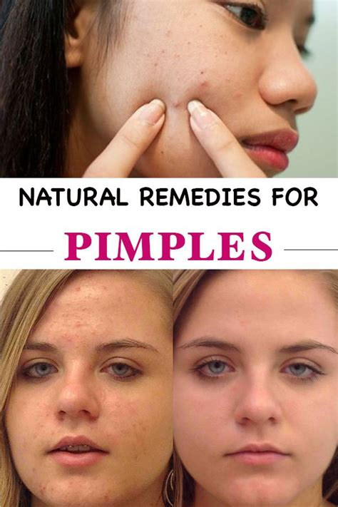 Natural Remedies For Pimples Everything In One Place