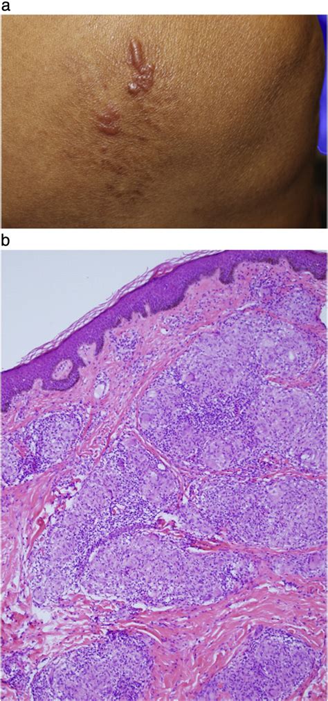 The Sarcoidal Granuloma A Unifying Hypothesis For An Enigmatic