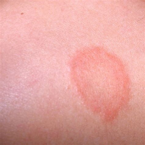 Fungal Infection Of The Skin Ringworm Ais Clinic