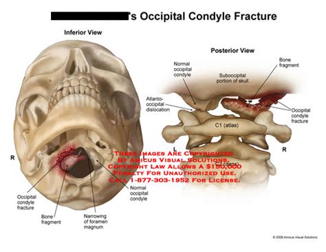 Amicus Illustration Of Amicus Injury Fracture Condyle Occipital Bone Fragment Foramen Magnum