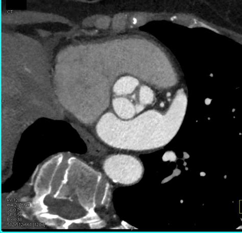 Dilated Ascending Thoracic Aorta Chest Case Studies Ctisus Ct Scanning