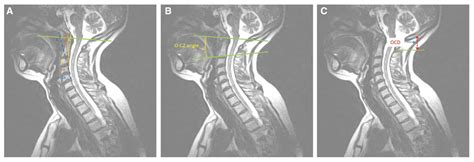 Impact Of Cervical Sagittal Balance And Cervical Spine Alignment On