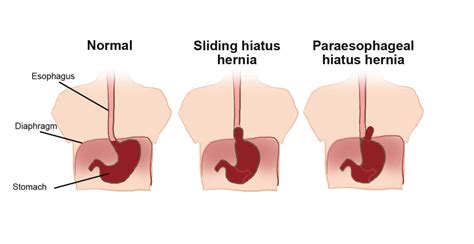 Find the perfect hiatal hernia stock photo. Hiatal hernia | Gastrointestinal Disorders articles | Body & Health Conditions center ...