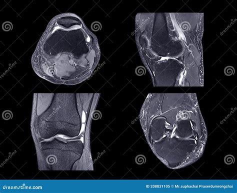Magnetic Resonance Imaging Or Mri Knee Comparison Sagittal Pdw And Tiw View Stock Image Image