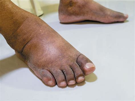 A Gp Guide To Managing Diabetes Related Foot Ulceration Australian