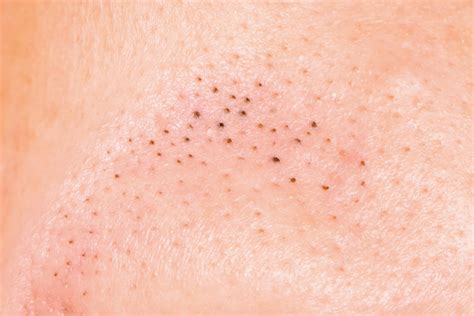 Blackheads On Breasts Tips And Tricks To Get Rid Of Blackheads On