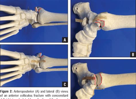 Medial Malleolar Fractures And Associated Deltoid Ligament Disruptions