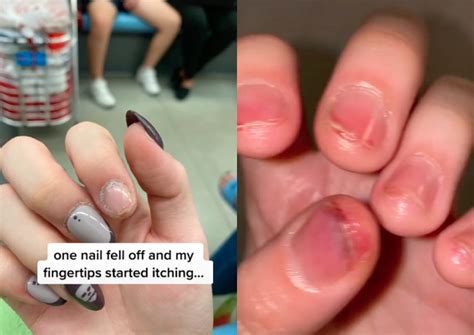 Itchy Fingers Woman Says Manicure Gave Her Blisters And Pus Singapore