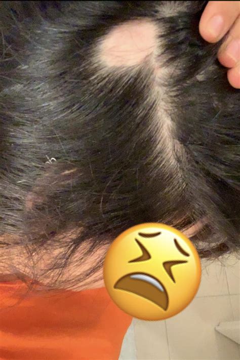 Kadınlarda bölgesel saç dökülmesi neden olur? - KizlarSoruyor