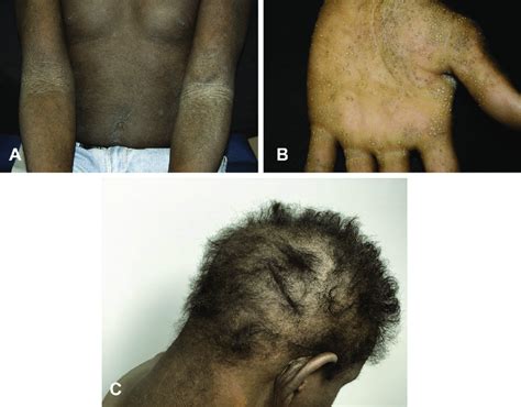 Clinical Features A Diffuse Lichenified And Hyperpigmented Patches
