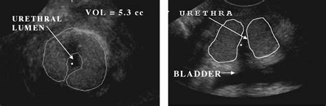 Three Dimensional Ultrasonography To Assess Long Term Durability Of