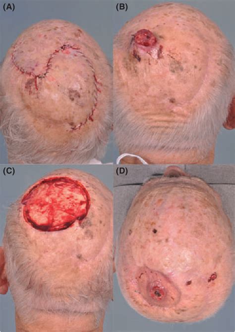 Figure From Reconstruction Of Scalp Wounds With Exposed Calvarium Using A Local Flap And A