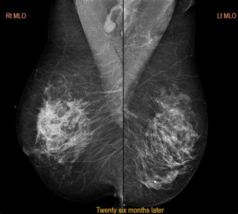 Bilateral Breast Cancer Mammography Histology Correlation
