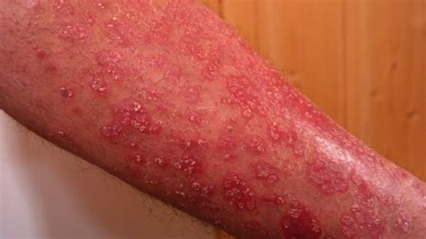 psoriasis qué es síntomas causas y tipos de esta enfermedad de la piel