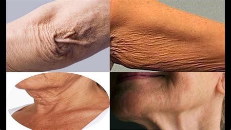 How To Get Rid Of Crepey Skin On Face Neck Legs Upper Arms Under