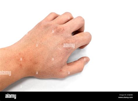 Cracked Skin High Resolution Stock Photography And Images Alamy