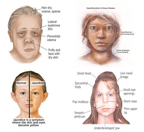 Disease Specific Faces Ieee Dataport