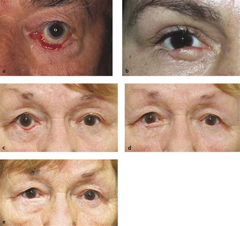 12 Eyelid And Periocular Reconstruction Plastic Surgery Key